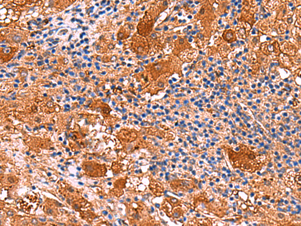 Immunohistochemistry of paraffin-embedded Human liver cancer tissue using TA368592 (KANK3 Antibody) at dilution 1/50 (Original magnification: x200)