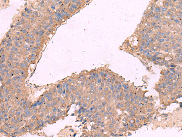 Immunohistochemistry of paraffin-embedded Human liver cancer tissue using TA368611 (KCNN3 Antibody) at dilution 1/40 (Original magnification: x200)