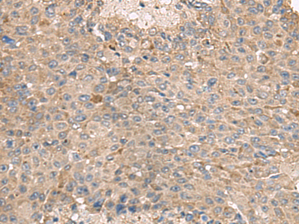 Immunohistochemistry of paraffin-embedded Human liver cancer tissue using TA368619 (ABCA10 Antibody) at dilution 1/50 (Original magnification: x200)