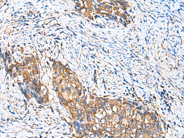 Immunohistochemistry of paraffin-embedded Human cervical cancer tissue using TA368629 (CAMSAP3 Antibody) at dilution 1/110 (Original magnification: x200)