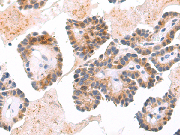 Immunohistochemistry of paraffin-embedded Human thyroid cancer tissue using TA368638 (ARRDC4 Antibody) at dilution 1/65 (Original magnification: x200)