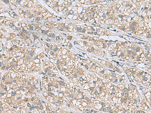 Immunohistochemistry of paraffin-embedded Human liver cancer tissue using TA368666 (HSPB11 Antibody) at dilution 1/20 (Original magnification: x200)