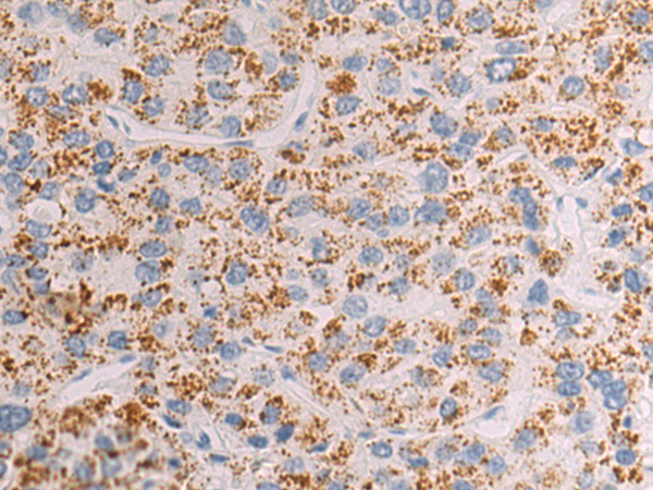 Immunohistochemistry of paraffin-embedded Human liver cancer tissue using TA368718 (SLC22A7 Antibody) at dilution 1/50 (Original magnification: x200)