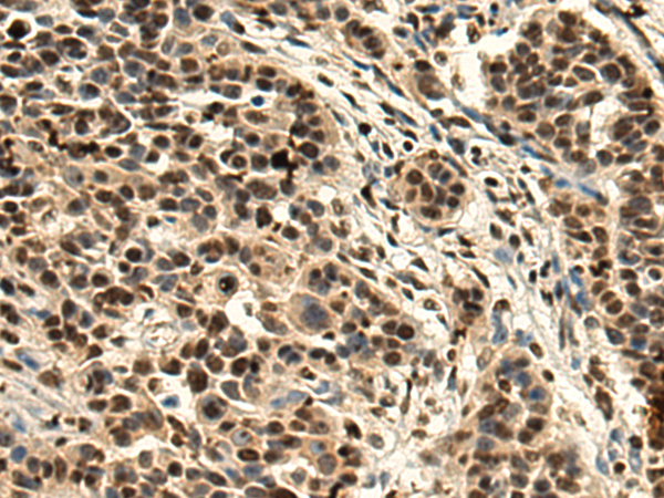 Immunohistochemistry of paraffin-embedded Human thyroid cancer tissue using TA368731 (PCP4 Antibody) at dilution 1/160 (Original magnification: x200)