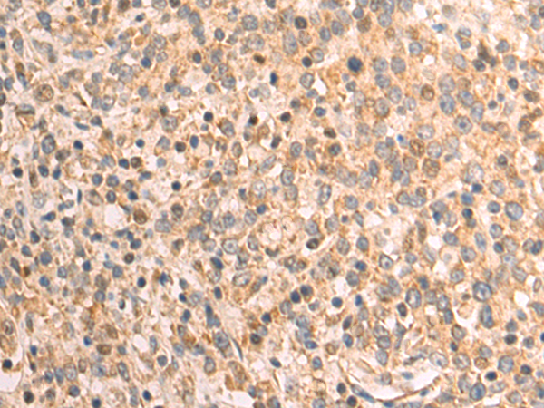 Immunohistochemistry of paraffin-embedded Human gastric cancer tissue using TA368733 (DAZ4 Antibody) at dilution 1/115 (Original magnification: x200)