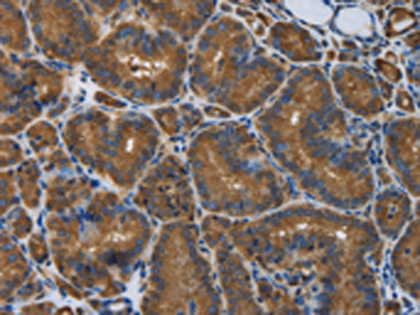 Immunohistochemistry of paraffin-embedded Human thyroid cancer tissue using TA368740 (SNCG Antibody) at dilution 1/50. (Original magnification: x200)