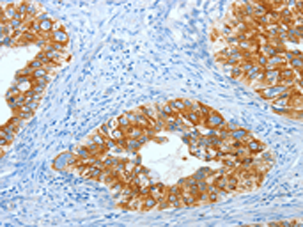 Immunohistochemistry of paraffin-embedded Human cervical cancer tissue using TA368749 (KRT40 Antibody) at dilution 1/30 (Original magnification: x200)