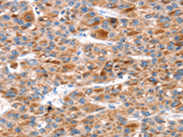 Immunohistochemistry of paraffin-embedded Human liver cancer tissue using TA368818 (KCNH6 Antibody) at dilution 1/30 (Original magnification: x200)
