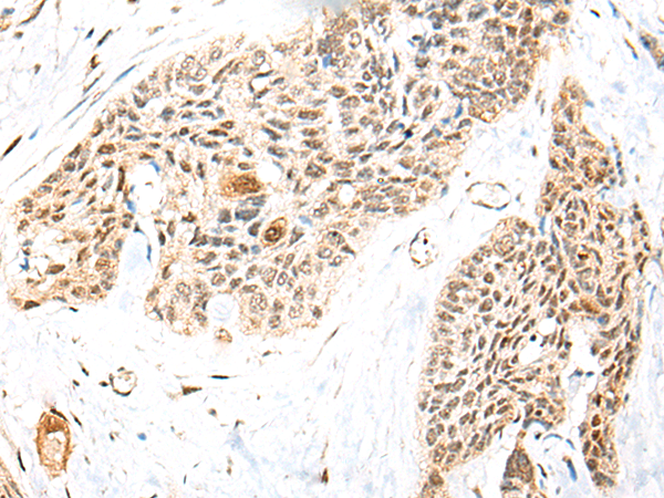 Immunohistochemistry of paraffin-embedded Human esophagus cancer tissue using TA368874 (RBMS2 Antibody) at dilution 1/35. (Original magnification: x200)