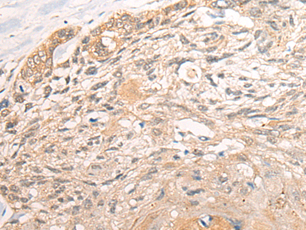 Immunohistochemistry of paraffin-embedded Human esophagus cancer tissue using TA368887 (NR2C2AP Antibody) at dilution 1/25. (Original magnification: x200)