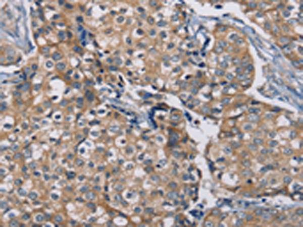 Immunohistochemistry of paraffin-embedded Human breast cancer tissue using TA368903 (AAAS Antibody) at dilution 1/20 (Original magnification: x200)