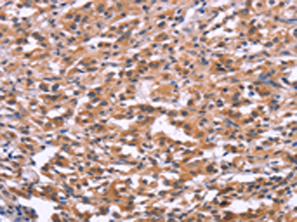 Immunohistochemistry of paraffin-embedded Human thyroid cancer tissue using TA368945 (USP2 Antibody) at dilution 1/30 (Original magnification: x200)