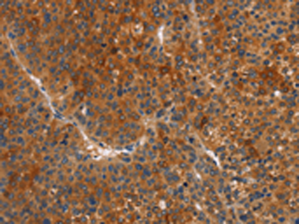 Immunohistochemistry of paraffin-embedded Human liver cancer tissue using TA368962 (MAPK15 Antibody) at dilution 1/15 (Original magnification: x200)