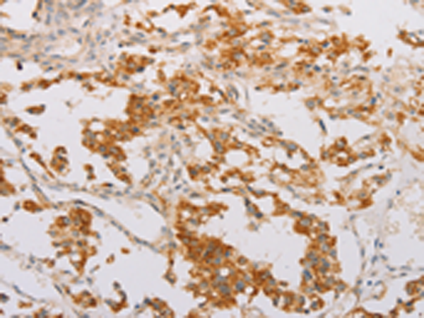 Immunohistochemistry of paraffin-embedded Human thyroid cancer tissue using TA368964 (STK40 Antibody) at dilution 1/40 (Original magnification: x200)