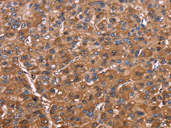 Immunohistochemistry of paraffin-embedded Human liver cancer tissue using TA368977 (ELP2 Antibody) at dilution 1/40 (Original magnification: x200)