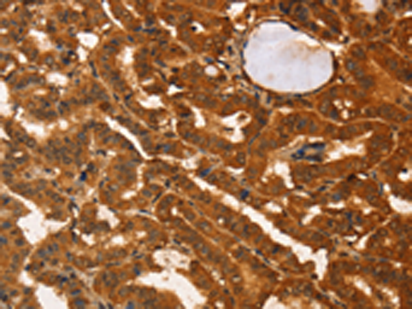 Immunohistochemistry of paraffin-embedded Human thyroid cancer tissue using TA368992 (IKZF3 Antibody) at dilution 1/60 (Original magnification: x200)