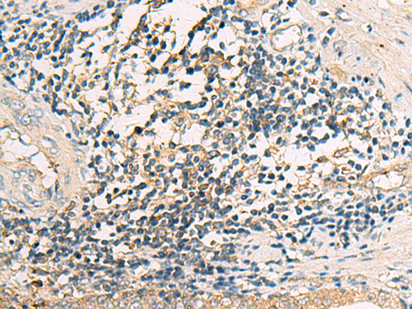 Immunohistochemistry of paraffin-embedded Human prostate cancer tissue using TA368996 (ASB10 Antibody) at dilution 1/35 (Original magnification: x200)