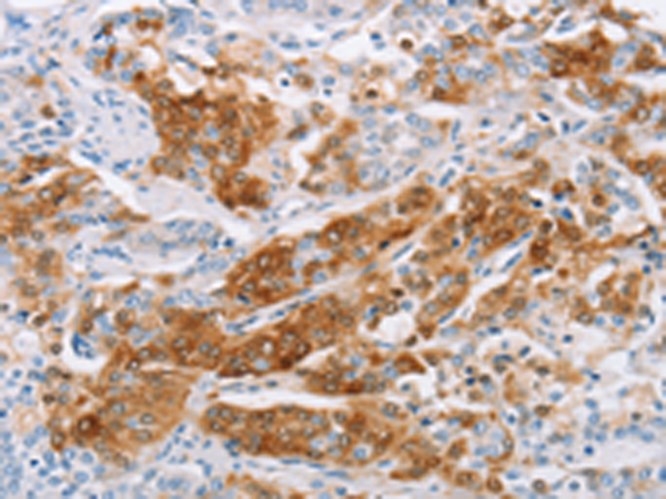 Immunohistochemistry of paraffin-embedded Human prostate cancer tissue using TA369008 (C3AR1 Antibody) at dilution 1/25 (Original magnification: x200)