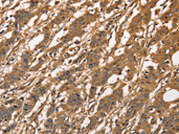 Immunohistochemistry of paraffin-embedded Human gasrtic cancer tissue using TA369015 (CAPZA3 Antibody) at dilution 1/40 (Original magnification: x200)