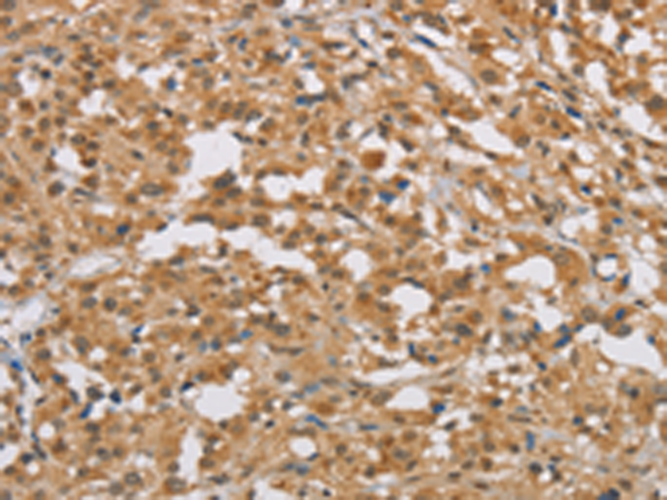 Immunohistochemistry of paraffin-embedded Human thyroid cancer tissue using TA369070 (DIDO1 Antibody) at dilution 1/50 (Original magnification: x200)