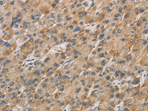 Immunohistochemistry of paraffin-embedded Human liver cancer tissue using TA369079 (DDIT4L Antibody) at dilution 1/20 (Original magnification: x200)