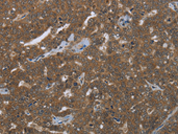 Immunohistochemistry of paraffin-embedded Human ovarian cancer tissue using TA369122 (FASTKD1 Antibody) at dilution 1/50 (Original magnification: x200)