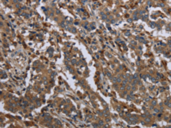 Immunohistochemistry of paraffin-embedded Human liver cancer tissue using TA369149 (GYS2 Antibody) at dilution 1/40 (Original magnification: x200)