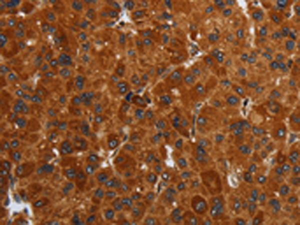 Immunohistochemistry of paraffin-embedded Human liver cancer tissue using TA369208 (ENTPD7 Antibody) at dilution 1/40 (Original magnification: x200)