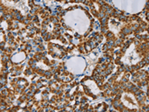 Immunohistochemistry of paraffin-embedded Human thyroid cancer tissue using TA369216 (CMC4 Antibody) at dilution 1/25 (Original magnification: x200)