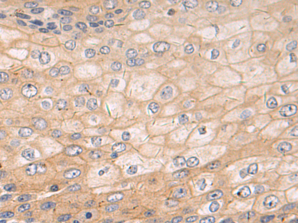 Immunohistochemistry of paraffin-embedded Human esophagus cancer tissue using TA369263 (PDLIM2 Antibody) at dilution 1/60 (Original magnification: x200)