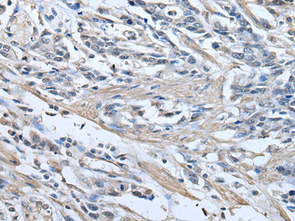 Immunohistochemistry of paraffin-embedded Human gastric cancer tissue using TA369273 (PRKAR2A Antibody) at dilution 1/30 (Original magnification: x200)
