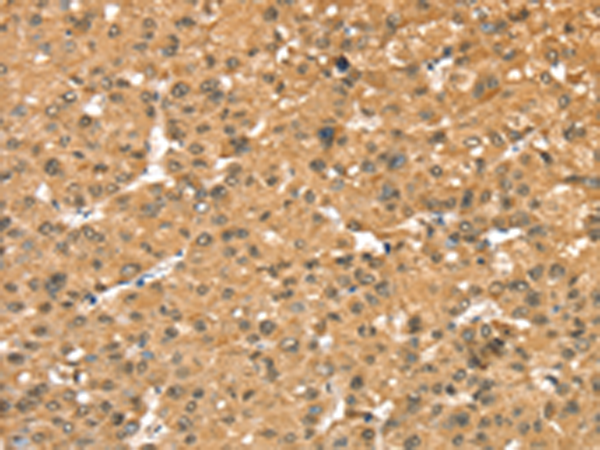 Immunohistochemistry of paraffin-embedded Human liver cancer tissue using TA369304 (RASSF9 Antibody) at dilution 1/40 (Original magnification: x200)