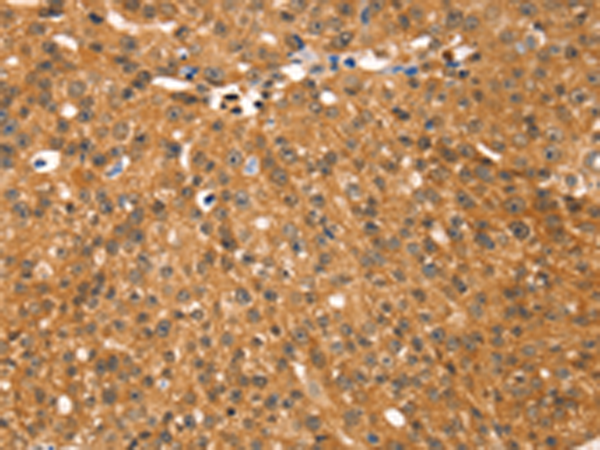Immunohistochemistry of paraffin-embedded Human breast cancer tissue using TA369316 (RGS22 Antibody) at dilution 1/25 (Original magnification: x200)