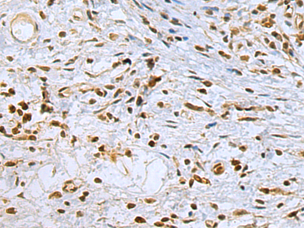 Immunohistochemistry of paraffin-embedded Human esophagus cancer tissue using TA369333 (STAG1 Antibody) at dilution 1/70 (Original magnification: x200)