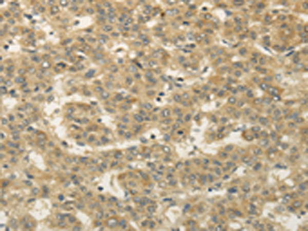 Immunohistochemistry of paraffin-embedded Human liver cancer tissue using TA369340 (SEMA4F Antibody) at dilution 1/30 (Original magnification: x200)