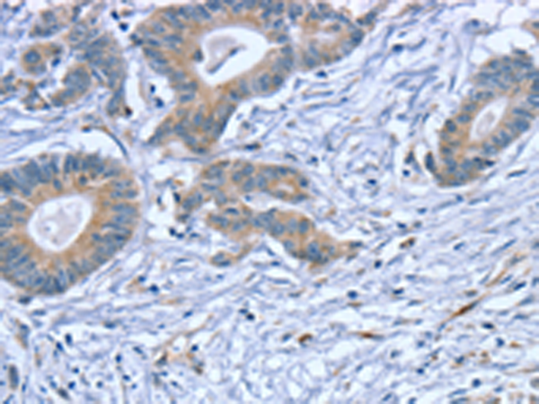 Immunohistochemistry of paraffin-embedded Human colon cancer tissue using TA369354 (SLITRK4 Antibody) at dilution 1/20 (Original magnification: x200)