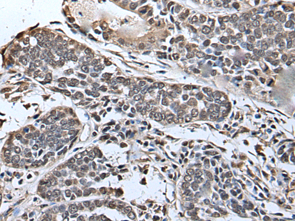Immunohistochemistry of paraffin-embedded Human esophagus cancer tissue using TA369355 (SLITRK5 Antibody) at dilution 1/45 (Original magnification: x200)
