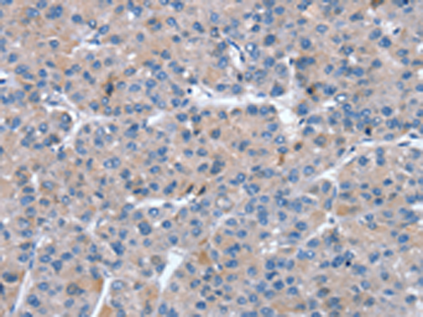 Immunohistochemistry of paraffin-embedded Human liver cancer tissue using TA369364 (SNX27 Antibody) at dilution 1/20 (Original magnification: x200)