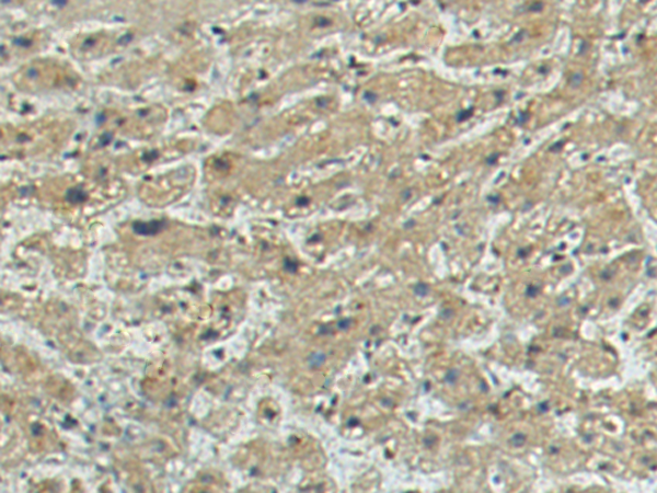 Immunohistochemistry of paraffin-embedded Human liver cancer tissue using TA369417 (TMEFF1 Antibody) at dilution 1/140 (Original magnification: x200)