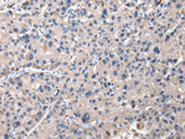 Immunohistochemistry of paraffin-embedded Human liver cancer tissue using TA369457 (CHMP3 Antibody) at dilution 1/20 (Original magnification: x200)