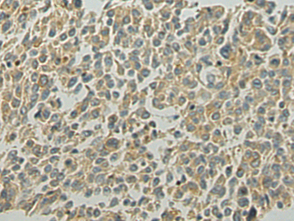 Immunohistochemistry of paraffin-embedded Human colorectal cancer tissue using TA369459 (VPS39 Antibody) at dilution 1/80 (Original magnification: x200)