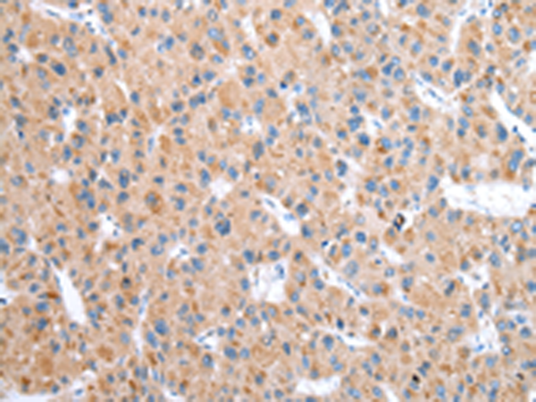 Immunohistochemistry of paraffin-embedded Human liver cancer tissue using TA369467 (CFAP52 Antibody) at dilution 1/25 (Original magnification: x200)