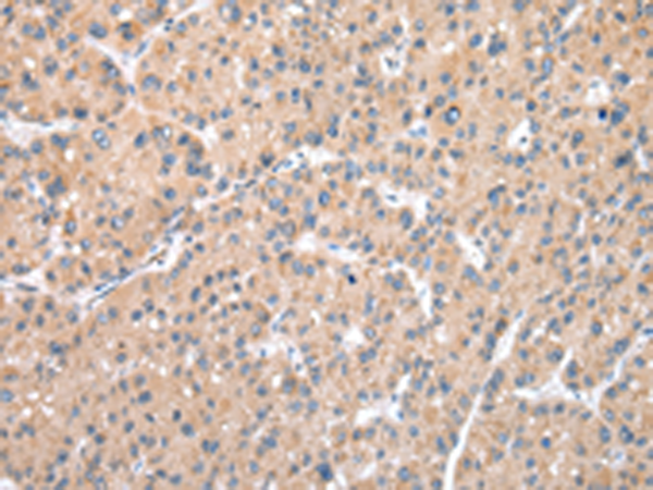 Immunohistochemistry of paraffin-embedded Human liver cancer tissue using TA369470 (DPH7 Antibody) at dilution 1/35 (Original magnification: x200)