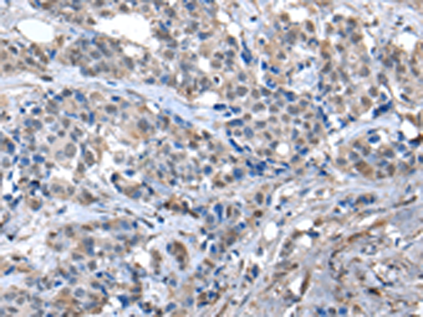 Immunohistochemistry of paraffin-embedded Human breast cancer tissue using TA369492 (ZFP2 Antibody) at dilution 1/40 (Original magnification: x200)