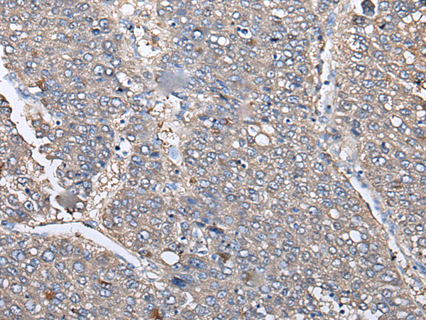 Immunohistochemistry of paraffin-embedded Human liver cancer tissue using TA369500 (KRT73 Antibody) at dilution 1/30 (Original magnification: x200)
