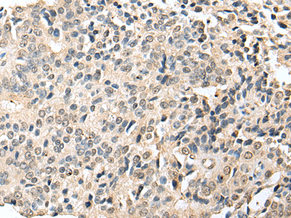 Immunohistochemistry of paraffin-embedded Human prostate cancer tissue using TA369519 (RABL2B Antibody) at dilution 1/20 (Original magnification: x200)