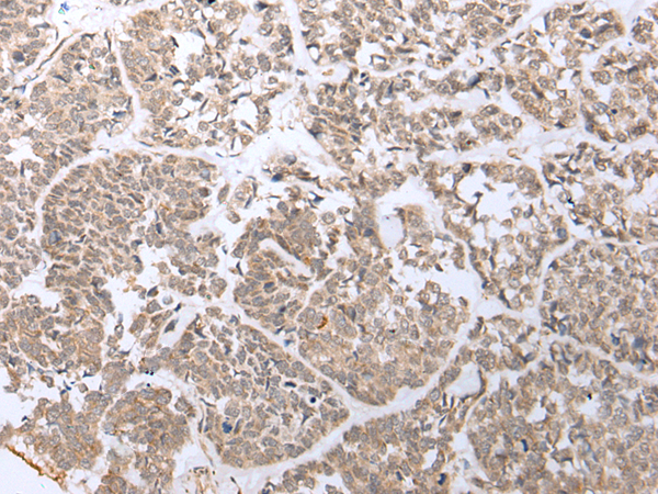 Immunohistochemistry of paraffin-embedded Human esophagus cancer tissue using TA369540 (PHTF2 Antibody) at dilution 1/20 (Original magnification: x200)