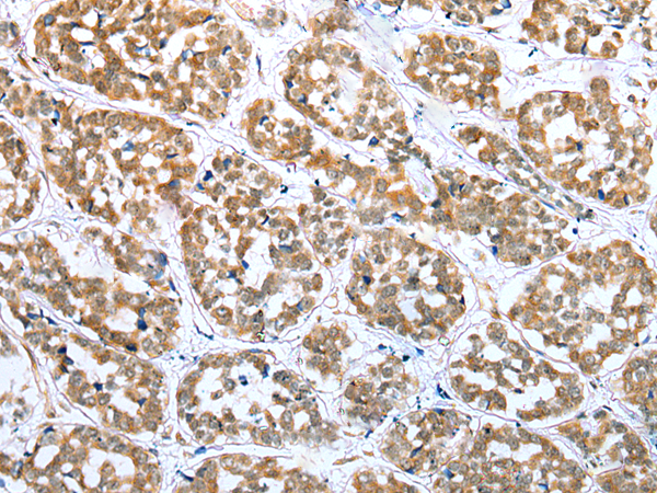 Immunohistochemistry of paraffin-embedded Human esophagus cancer tissue using TA369542 (ERMP1 Antibody) at dilution 1/30 (Original magnification: x200)