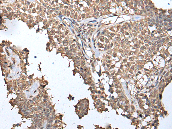 Immunohistochemistry of paraffin-embedded Human ovarian cancer tissue using TA369558 (METAP1D Antibody) at dilution 1/40 (Original magnification: x200)