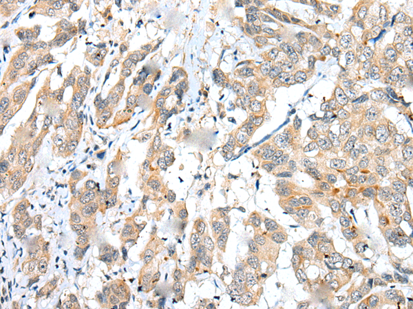 Immunohistochemistry of paraffin-embedded Human breast cancer tissue using TA369580 (FUOM Antibody) at dilution 1/25 (Original magnification: x200)